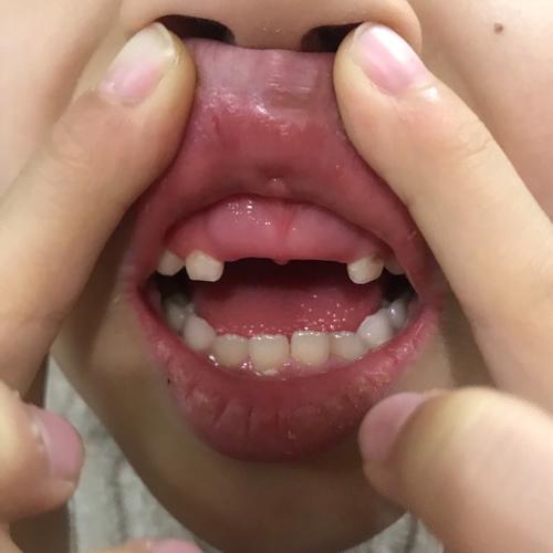 孩子乳牙断了半截