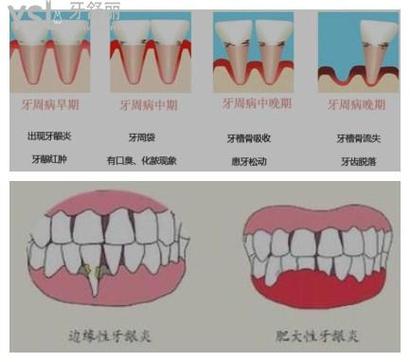 牙龈炎和牙周炎的区别的相关图片